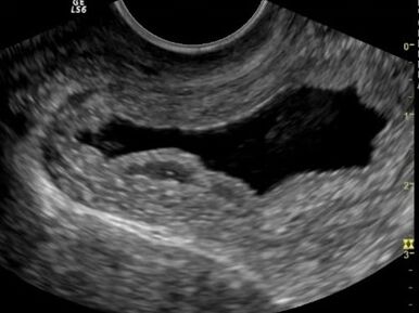 Ultrasound showed chronic cystitis. 